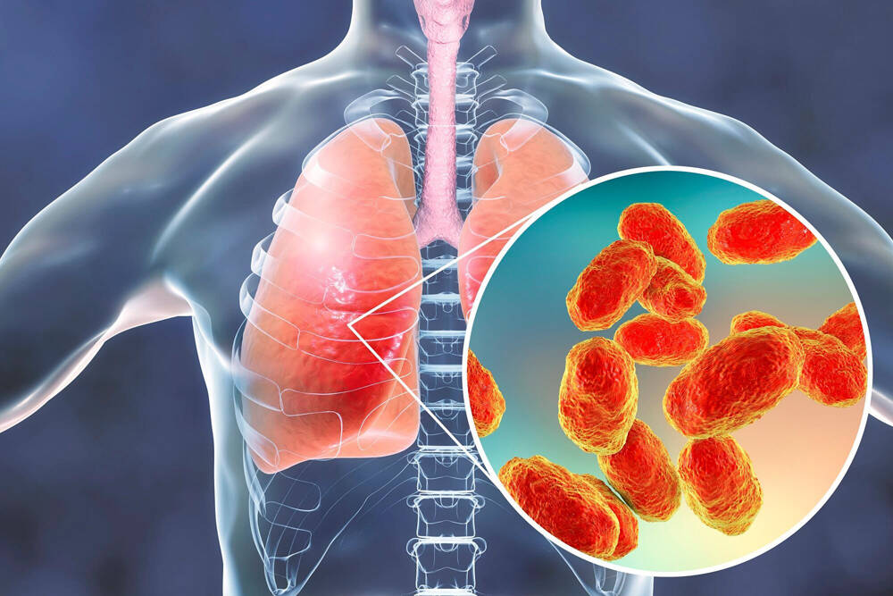 “Epidemia di polmonite più letale del Covid19 in Kazakistan”